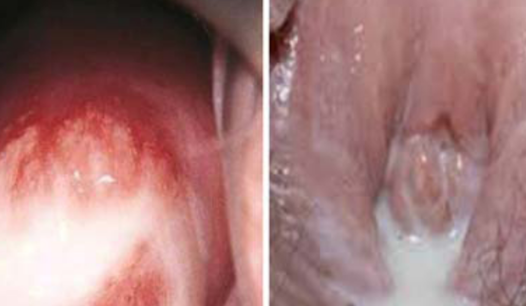 Hình ảnh bệnh lậu ở nữ