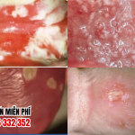 Hình ảnh bị nấm ở vùng kín
