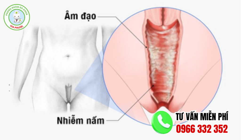 Hình Ảnh Bị Nấm Ở Vùng Kín Qua Từng Giai Đoạn (2026) 2 Hình ảnh bị nấm ở vùng kín