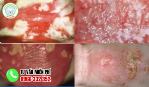 Hình ảnh bị nấm ở vùng kín