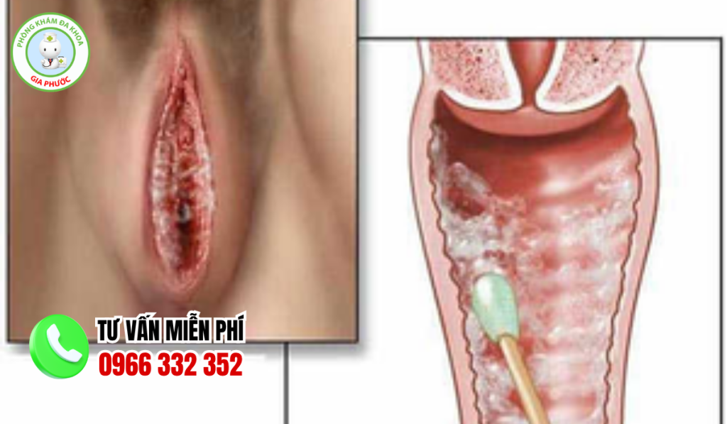 Hình Ảnh Bị Nấm Ở Vùng Kín Qua Từng Giai Đoạn (2026) 7 Hình ảnh bị nấm ở vùng kín
