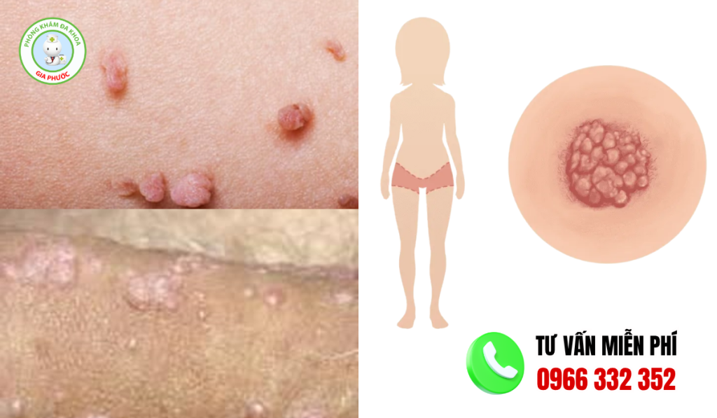 hình ảnh cục thịt thừa ở vùng kín