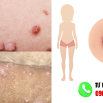 hình ảnh cục thịt thừa ở vùng kín