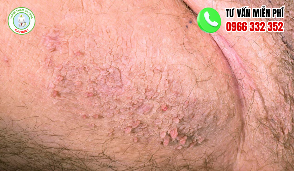 hình ảnh cục thịt thừa ở vùng kín