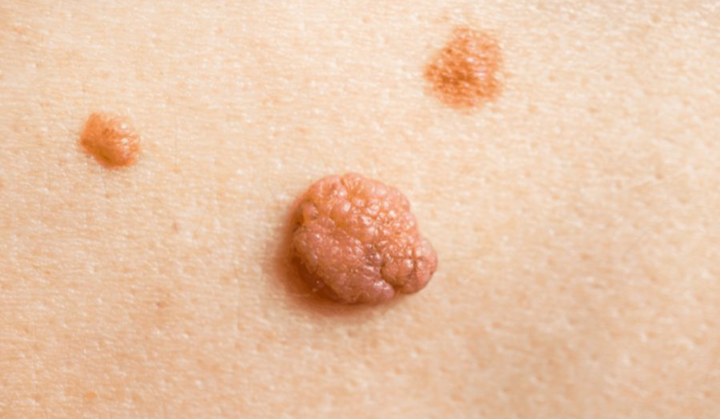 Hình ảnh cục thịt thừa ở vùng kín