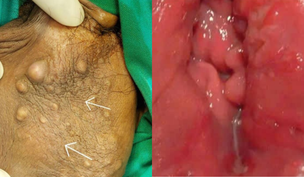 Hình ảnh cục thịt thừa ở vùng kín