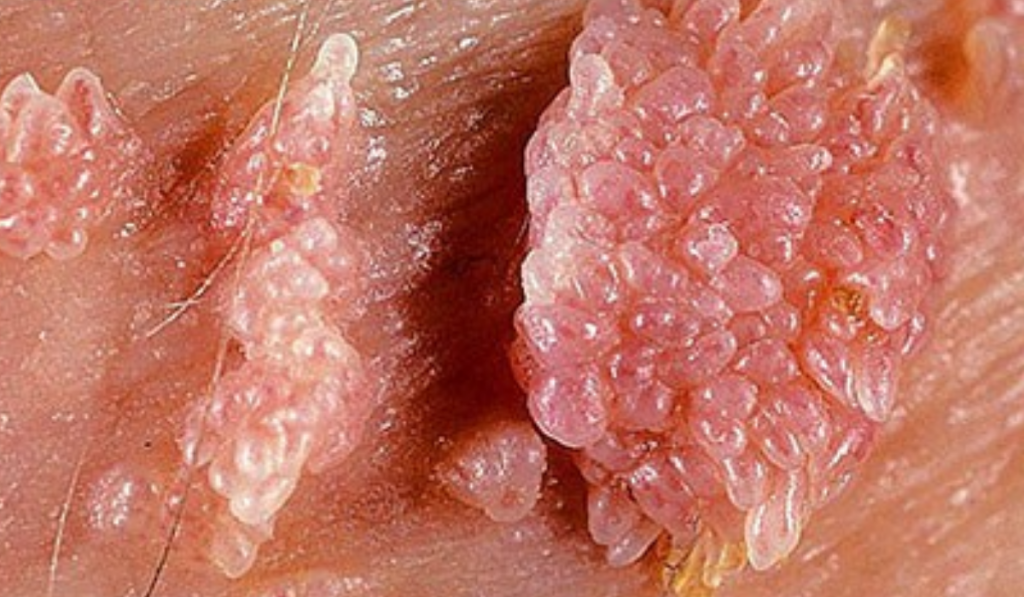 Hình ảnh cục thịt thừa ở vùng kín