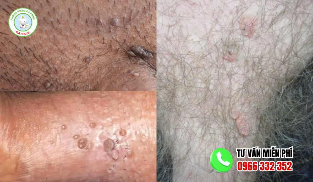 hình ảnh cục thịt thừa ở vùng kín nam