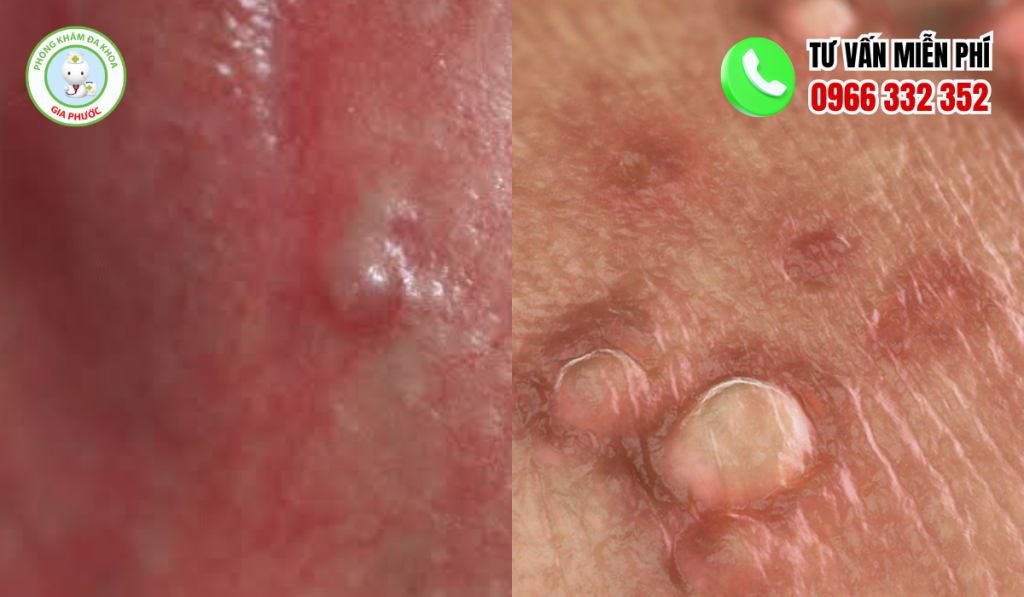 Hình ảnh cục thịt thừa ở vùng kín