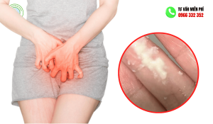 Hình ảnh khí hư bã đậu