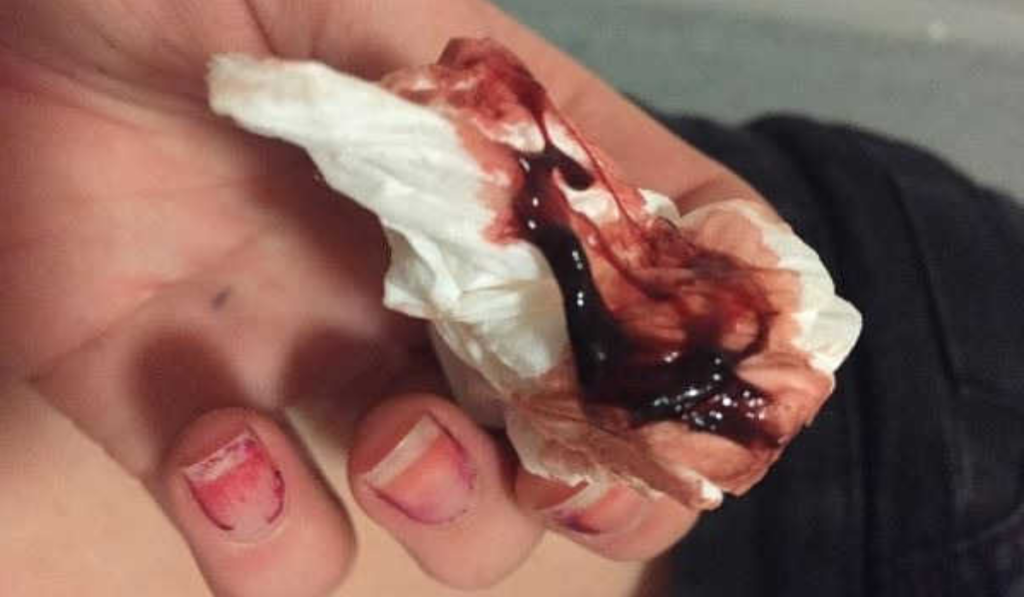 Hình ảnh kinh nguyệt vón cục bất thường