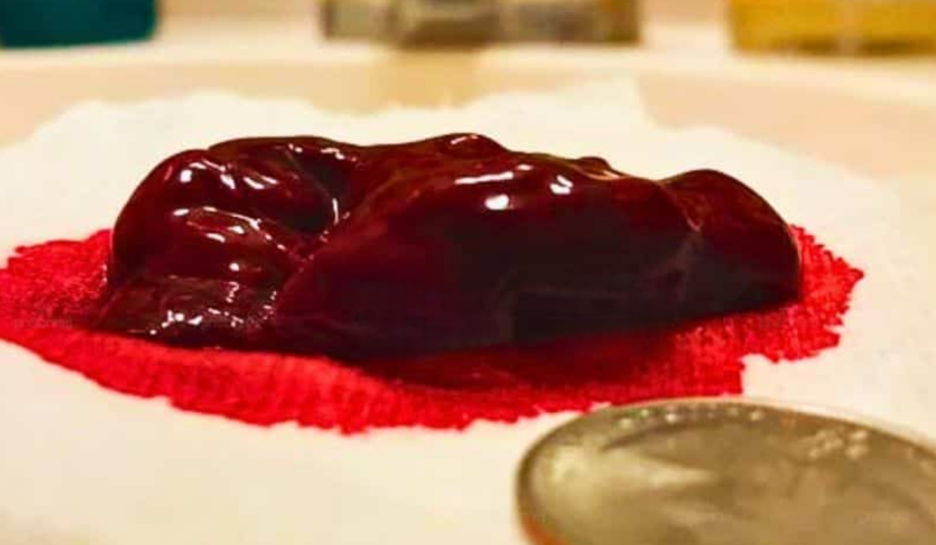 Hình ảnh kinh nguyệt vón cục bất thường