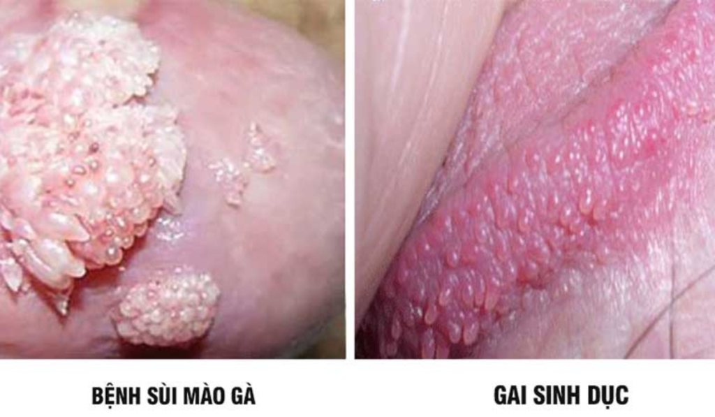 Hình ảnh nổi mụn ở vùng kín 