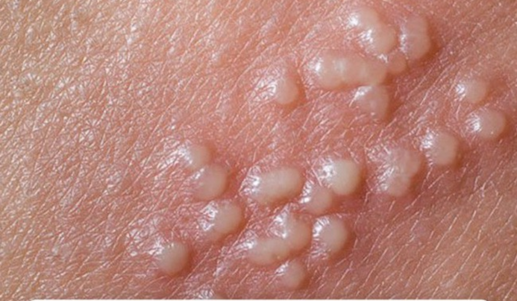 Hình ảnh nổi mụn ở vùng kín 