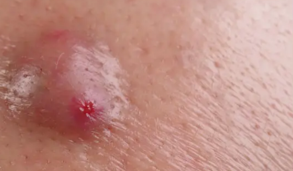 Hình ảnh nổi mụn ở vùng kín 