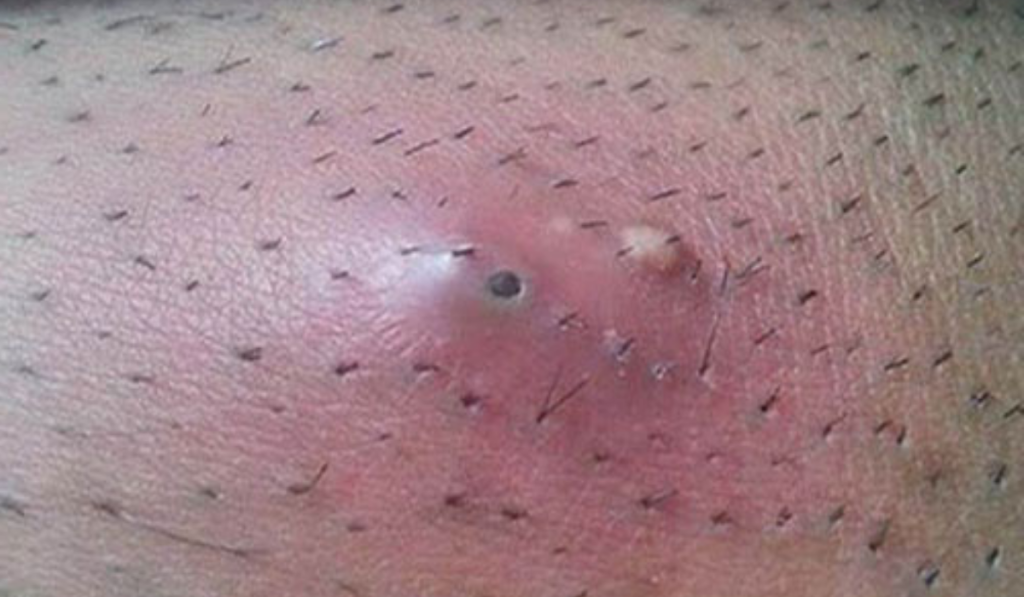 Hình ảnh nổi mụn ở vùng kín 