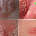 Hình Ảnh Nổi Mụn Ở Vùng Kín Nữ