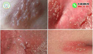 Hình Ảnh Nổi Mụn Ở Vùng Kín Nữ