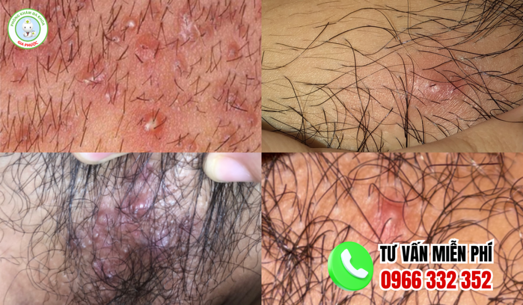 Hình ảnh nổi mụn ở vùng kín nữ