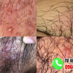 Hình ảnh nổi mụn ở vùng kín nữ