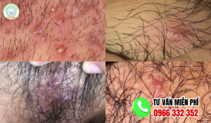 Hình ảnh nổi mụn ở vùng kín nữ