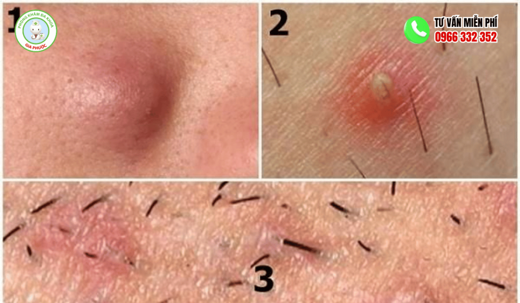 Hình Ảnh Nổi Mụn Ở Vùng Kín Nữ