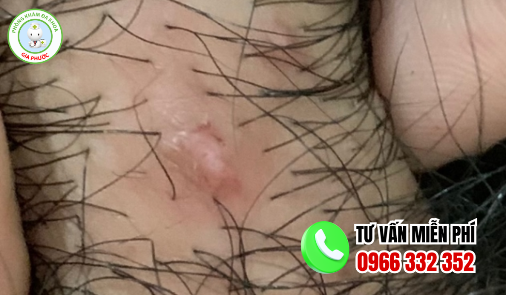 Hình ảnh nổi mụn ở vùng kín nữ