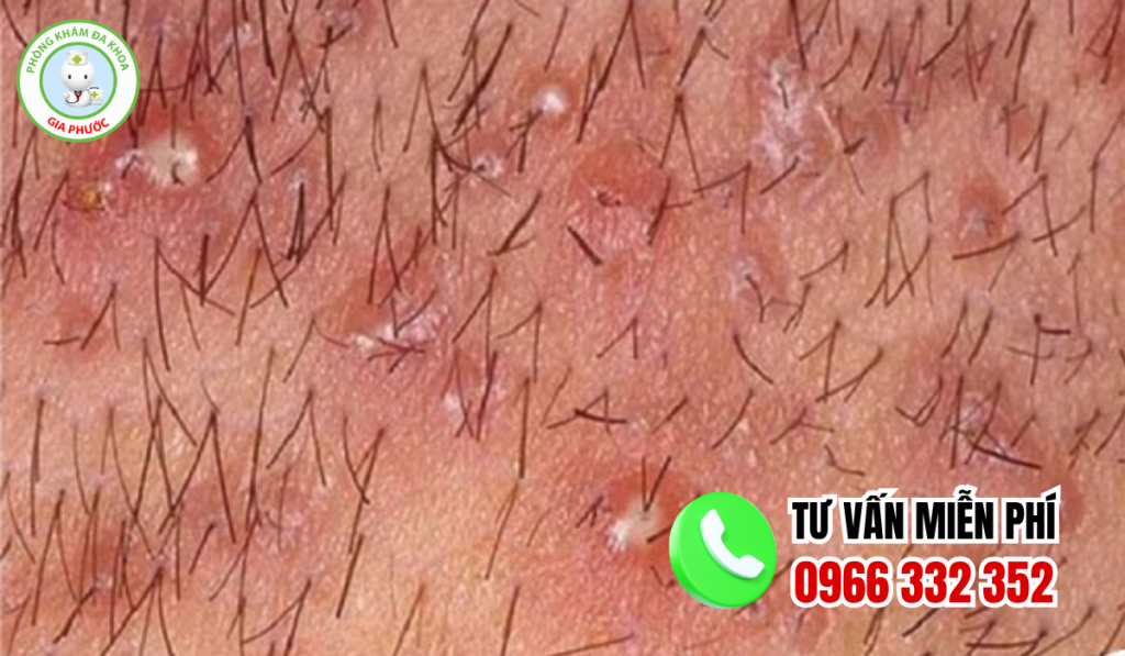 Hình ảnh nổi mụn ở vùng kín nữ