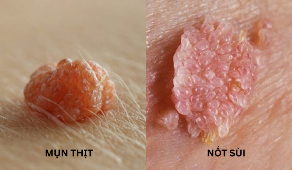 Hình ảnh nổi mụn ở vùng kín 