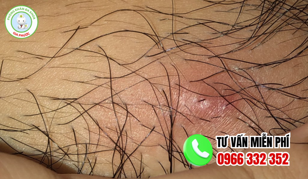 Hình ảnh nổi mụn ở vùng kín nữ