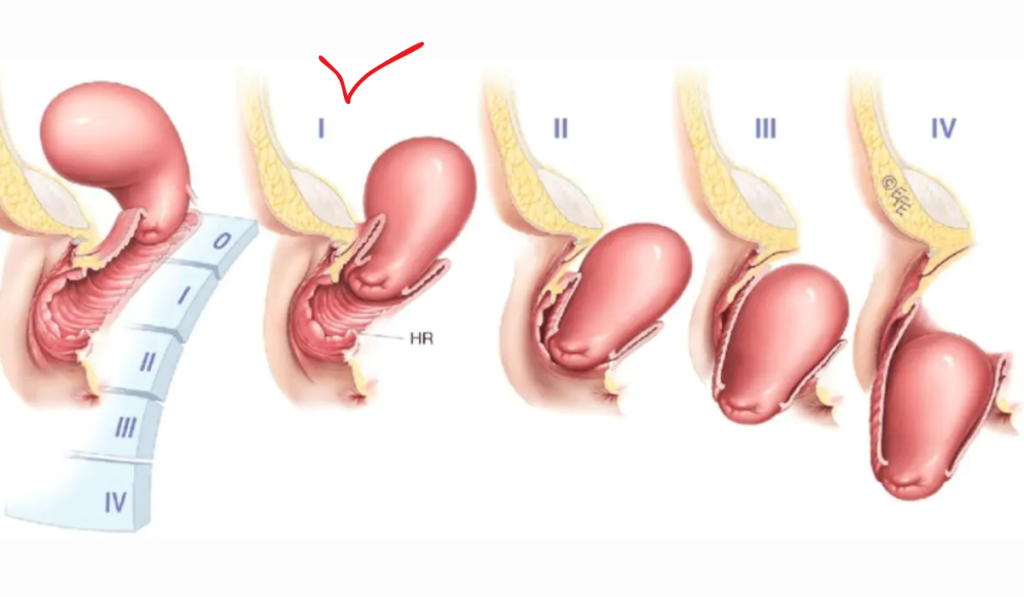 Hình ảnh sa tử cung 