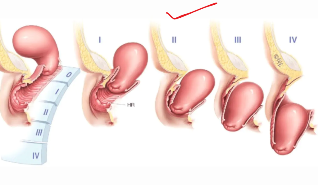 Hình ảnh sa tử cung 