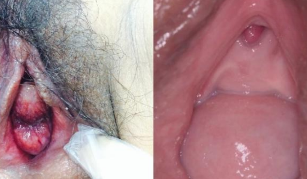 Hình ảnh sa tử cung