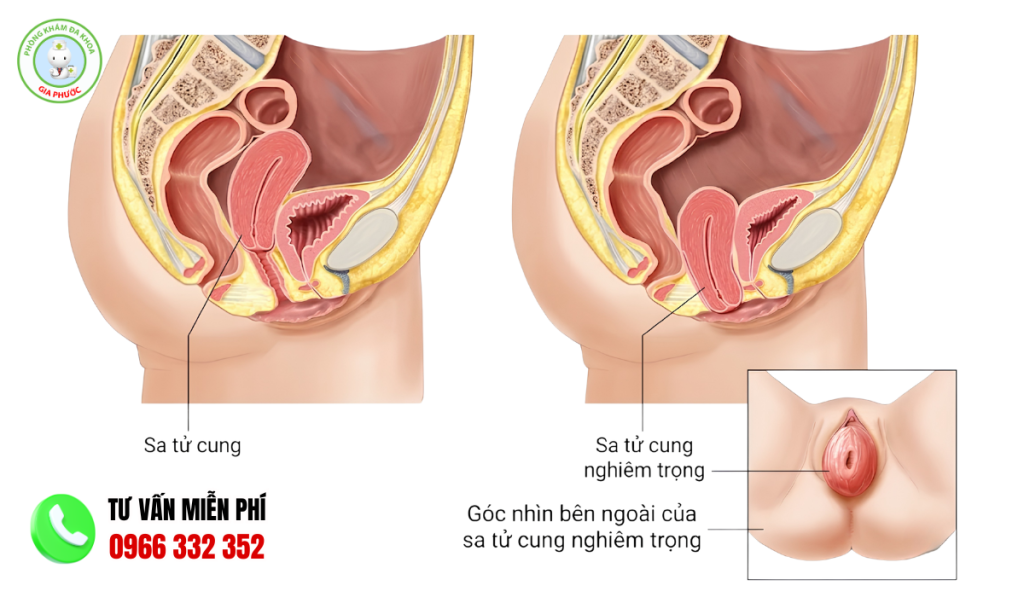 Hình ảnh sa tử cung chi tiết