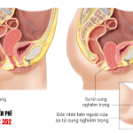Hình ảnh sa tử cung chi tiết