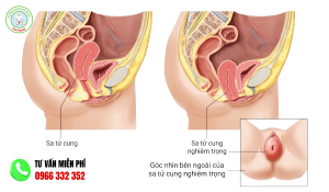 Hình ảnh sa tử cung chi tiết