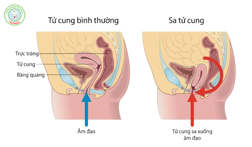 Hình ảnh sa tử cung sau sinh