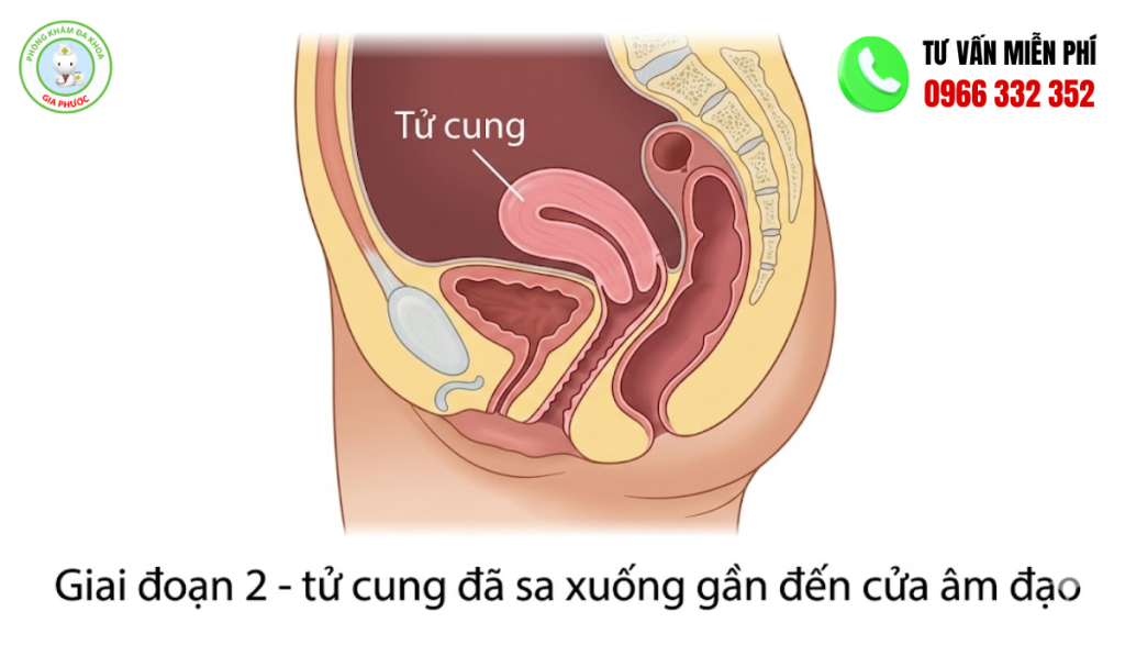 Hình ảnh sa tử cung độ 2