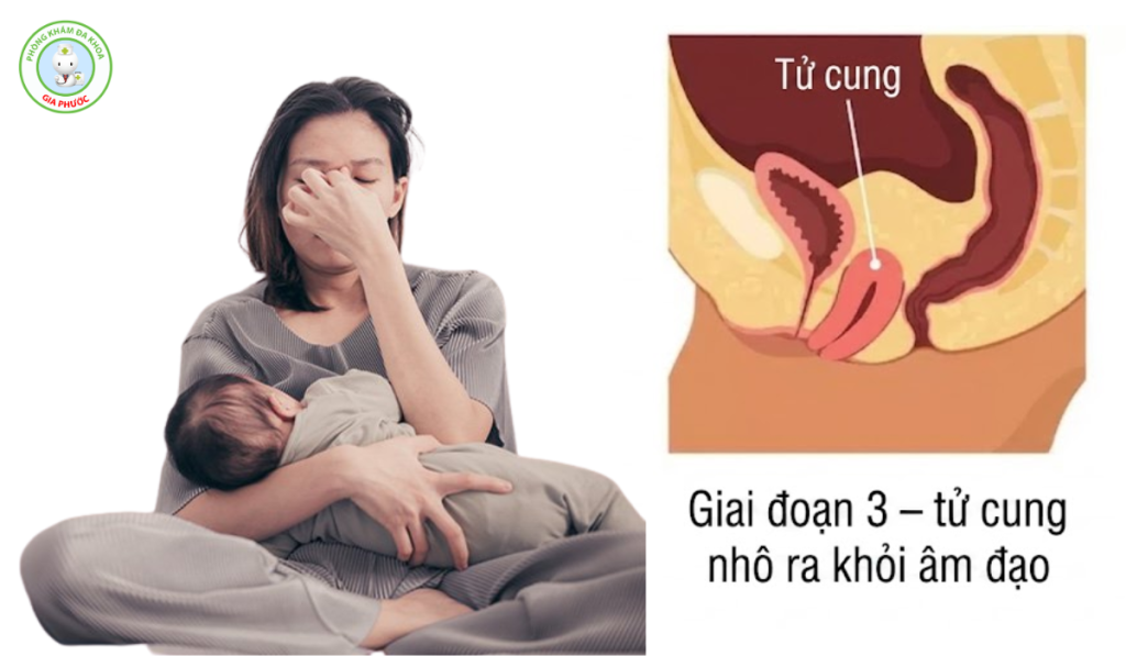 Hình ảnh sa tử cung sau sinh độ 3