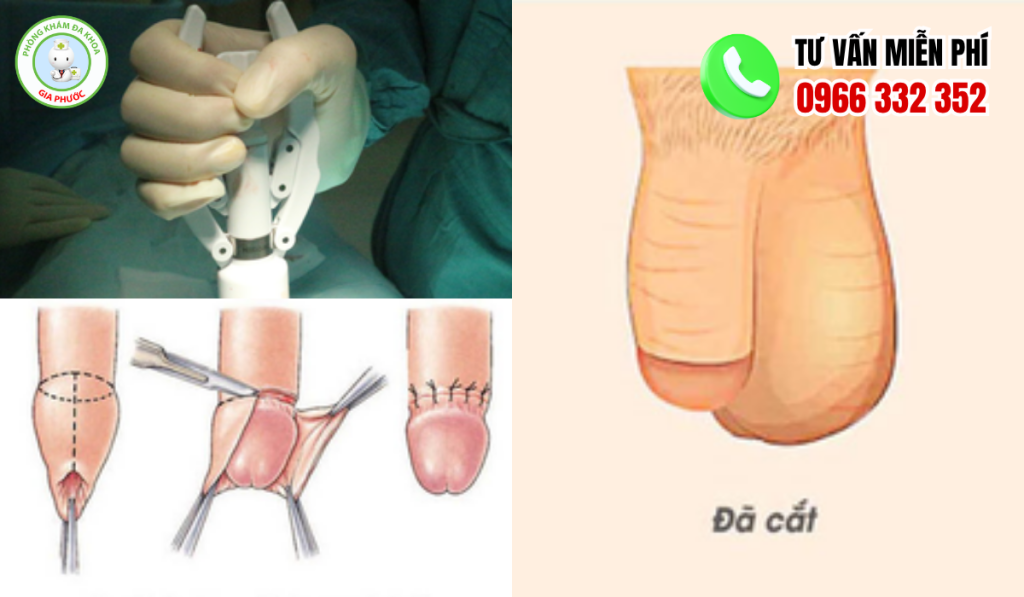 hình ảnh sau khi cắt bao quy đầu