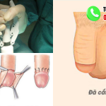 hình ảnh sau khi cắt bao quy đầu