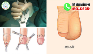 hình ảnh sau khi cắt bao quy đầu