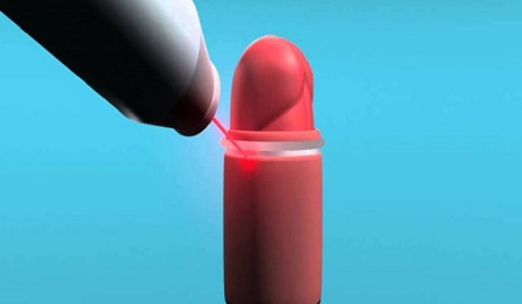 Hình ảnh sau khi cắt bao quy đầu bằng Laser