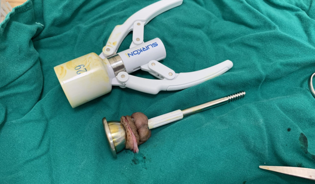 Hình ảnh sau khi cắt bao quy đầu bằng máy 