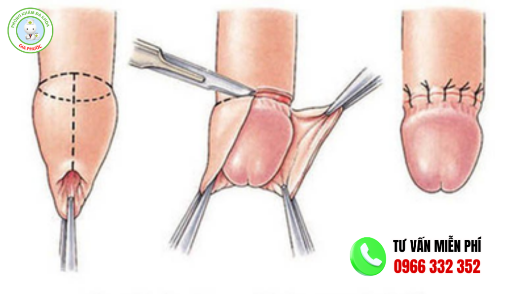 hình ảnh sau khi cắt bao quy đầu