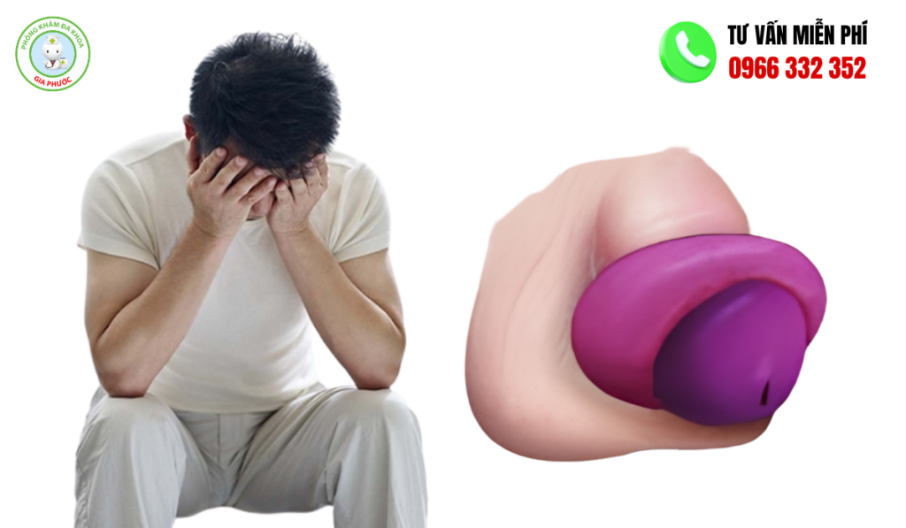 20+ Hình Ảnh Sau Khi Cắt Bao Quy Đầu Qua Từng Giai Đoạn 11 Hình ảnh sau khi cắt bao quy đầu phù nề