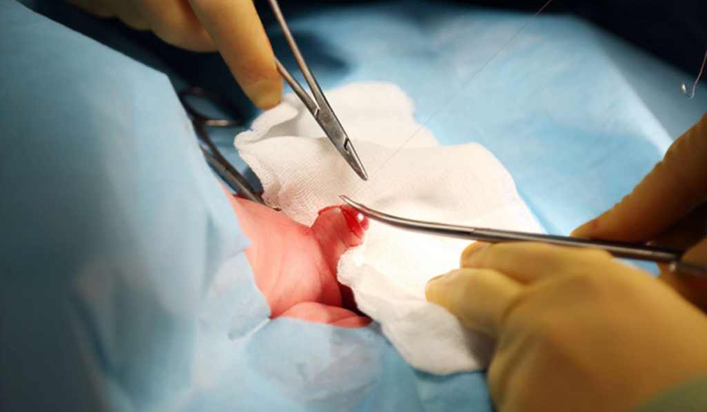 Hình ảnh sau khi cắt bao quy đầu truyền thống
