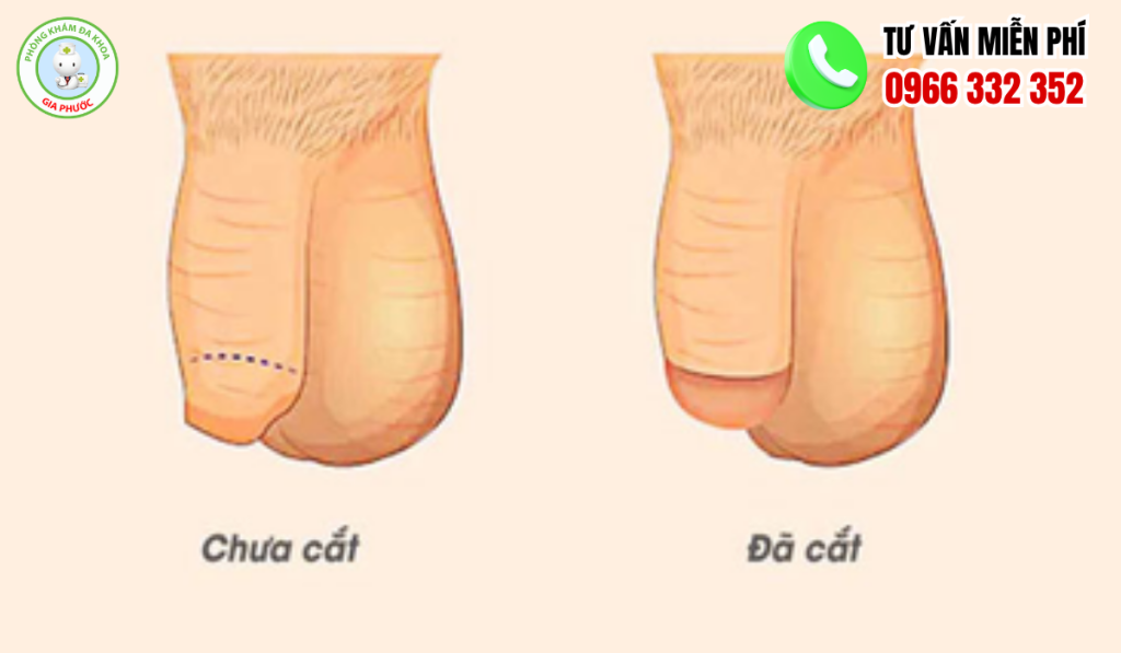 hình ảnh trước và sau khi cắt bao quy đầu