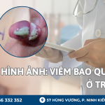 hình ảnh viêm bao quy đầu ở trẻ nhỏ