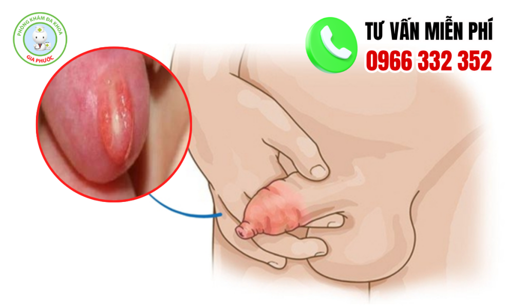 10+ hình ảnh viêm bao quy đầu ở trẻ nhỏ và cách xử lý cho mẹ 2 Hình ảnh viêm bao quy đầu ở trẻ